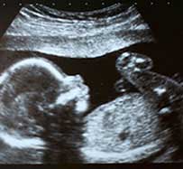 Obstetric Ultrasound - Tuckahoe, NY