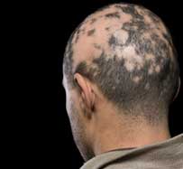 Alopecia Treatment | Hurst, TX