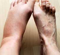 Edema Treatment in Portsmouth, NH
