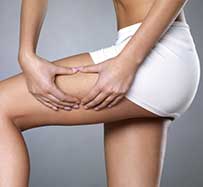 Extracorporeal Shock Wave Cellulite Treatment in Johnson City, TN