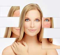 IPL Treatment for Rosacea | Raleigh, NC