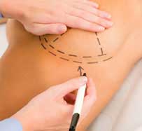 Breast Augmentation Surgery in Wilton Manors, FL