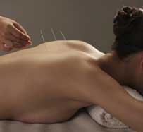 Acupuncture for Lower Back Pain
