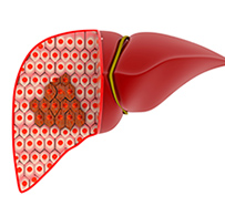 Benign Liver Tumor Johnson City │ Non-Cancerous Liver Tumor