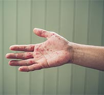Hand, Foot, and Mouth Disease Treatment in Lutz, FL