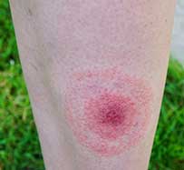 Lyme Disease Treatment in Annapolis, MD