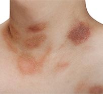 Pityriasis Rosea Treatment Roswell | Dermatologist in Roswell, GA