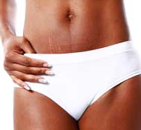 PRP for Stretch Marks Removal | Raleigh, NC