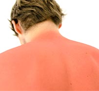 Sun Poisoning | Symptoms and Treatment | Johnson City
