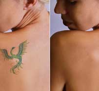 Tattoo Removal in Raleigh, NC